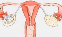 子宫多囊有什么症状？卵巢多囊样改变是什么意思？